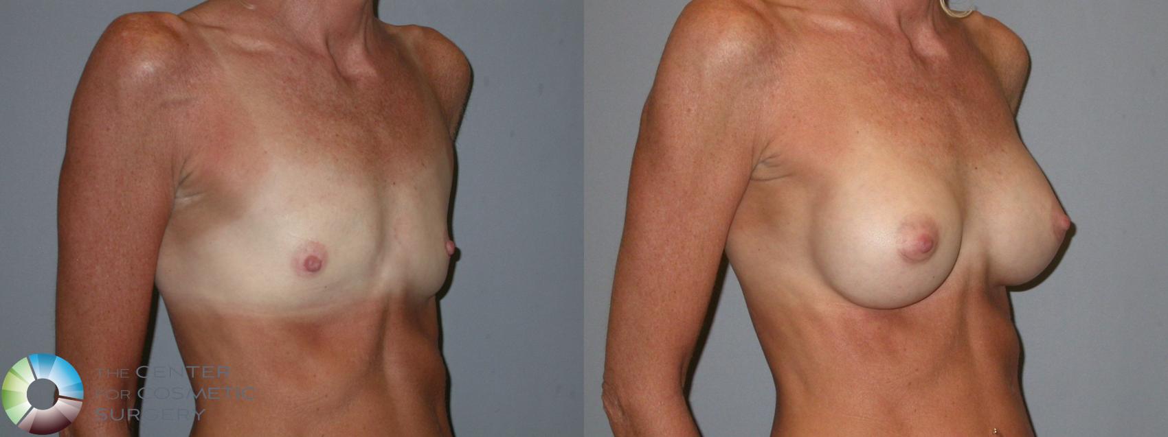 Before & After Breast Augmentation Case 104 View #1 View in Golden, CO
