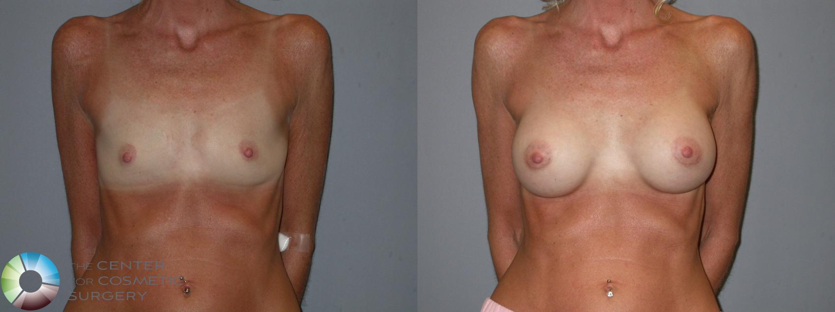 Before & After Breast Augmentation Case 104 View #2 View in Golden, CO