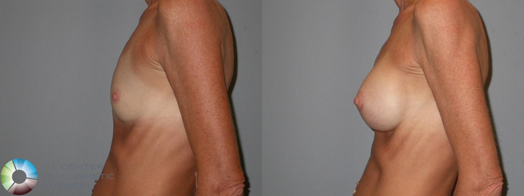 Before & After Breast Augmentation Case 104 View #3 View in Golden, CO
