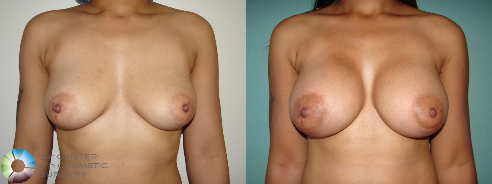 Before & After Breast Augmentation Case 10644 Anterior in Denver and Colorado Springs, CO