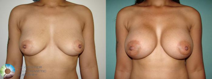 Before & After Breast Augmentation Case 10644 Anterior View in Golden, CO