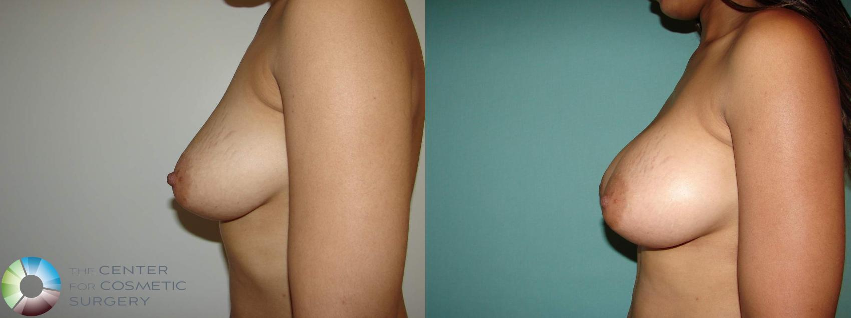 Before & After Breast Augmentation Case 10644 Left Lateral in Denver and Colorado Springs, CO