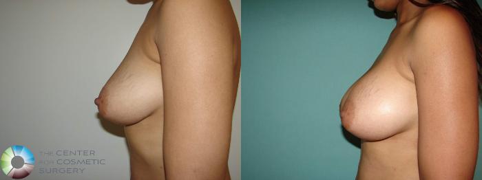 Before & After Breast Augmentation Case 10644 Left Lateral View in Golden, CO