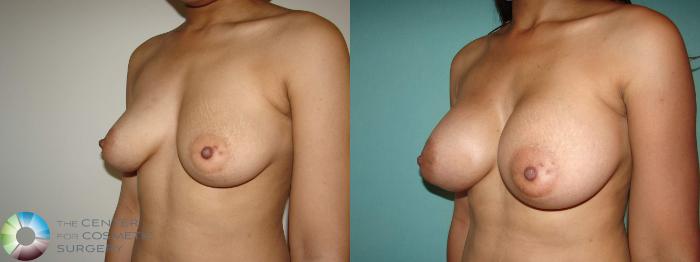 Before & After Breast Augmentation Case 10644 Left Oblique View in Golden, CO