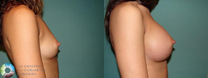 Before & After Breast Augmentation Case 10673 Right side in Denver and Colorado Springs, CO