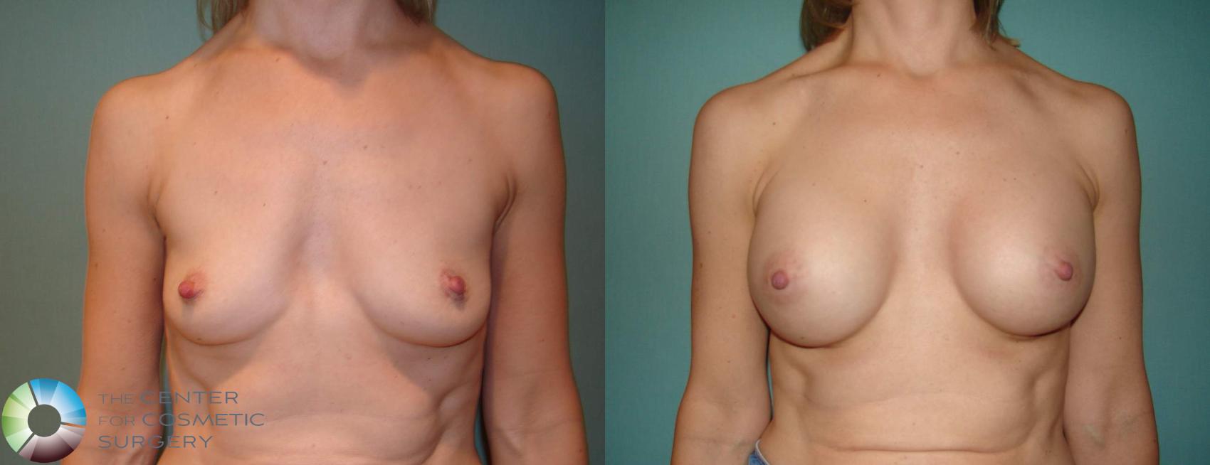 Before & After Breast Augmentation Case 10674 view-1 View in Golden, CO
