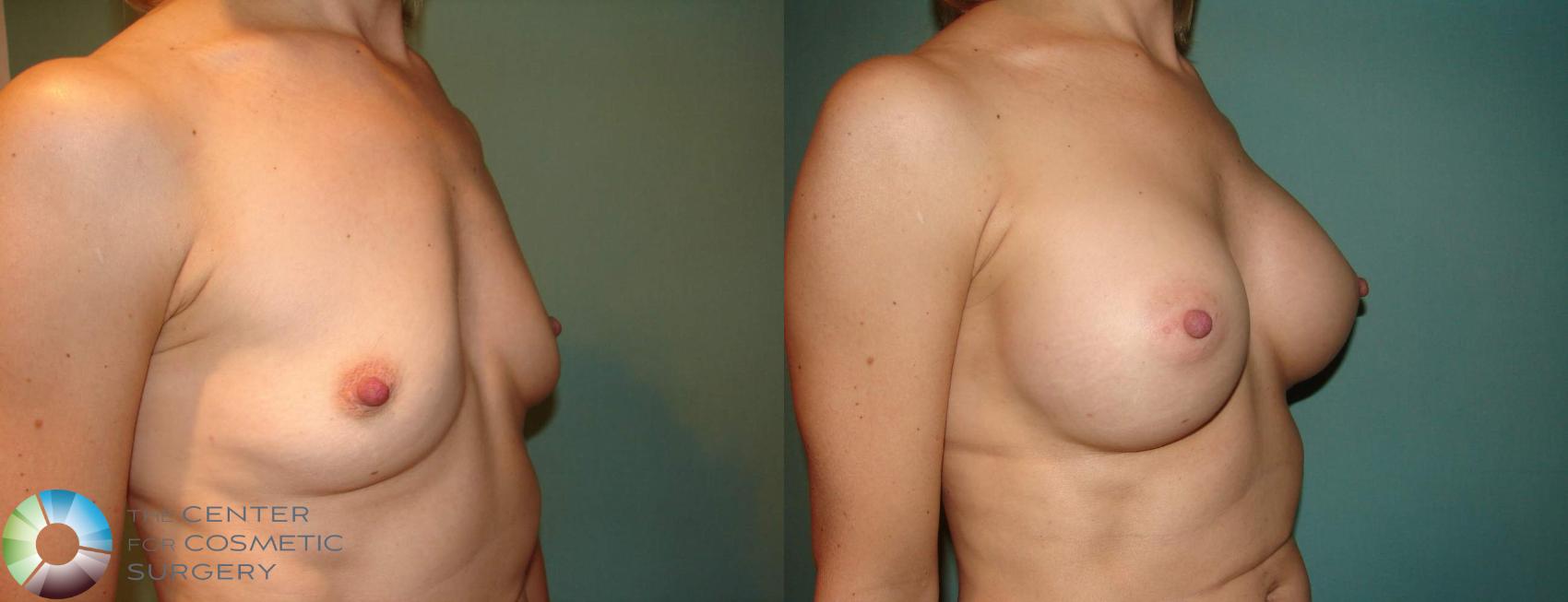 Before & After Breast Augmentation Case 10674 view-2 View in Golden, CO
