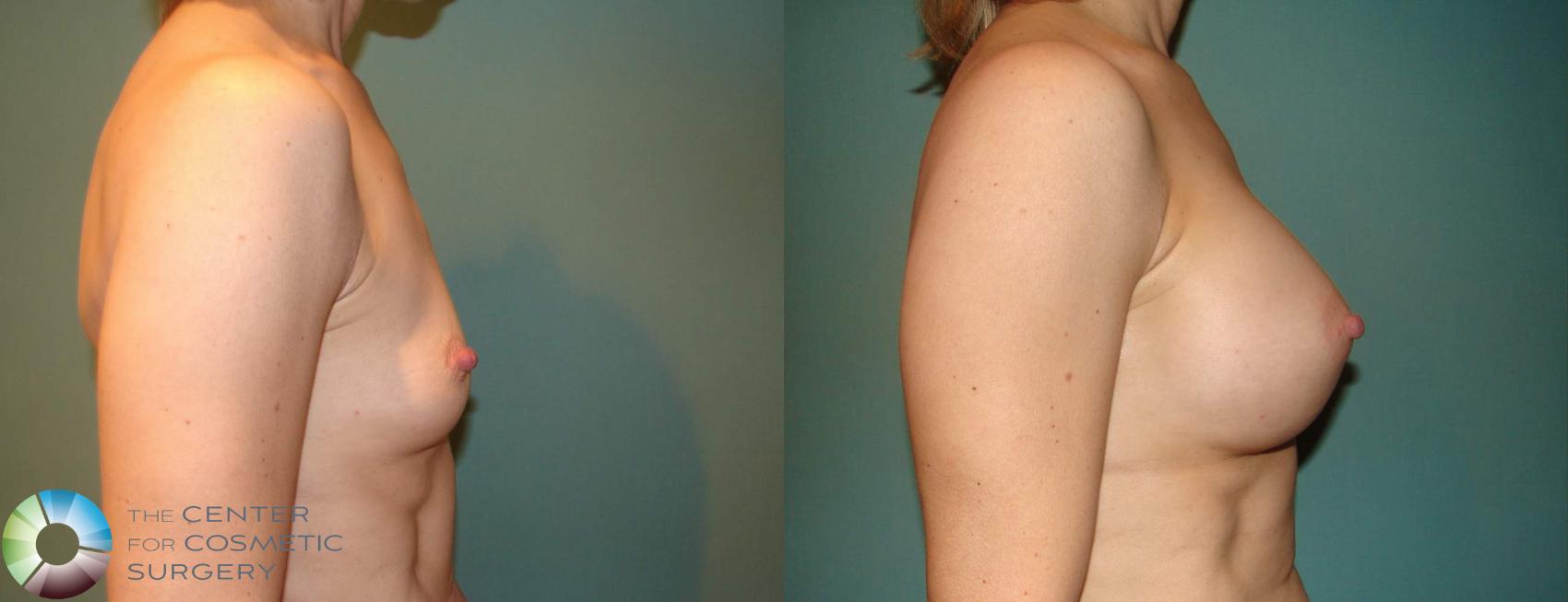 Before & After Breast Augmentation Case 10674 view-3 View in Golden, CO