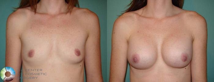 Before & After Breast Augmentation Case 10940 Anterior in Denver and Colorado Springs, CO