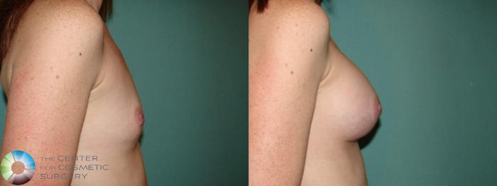 Before & After Breast Augmentation Case 10940 Right lateral in Denver and Colorado Springs, CO