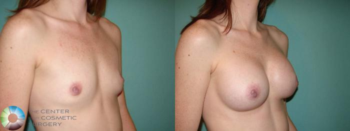 Before & After Breast Augmentation Case 10940 Right oblique in Denver and Colorado Springs, CO