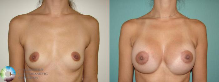 Before & After Breast Augmentation Case 10941 Anterior in Denver and Colorado Springs, CO