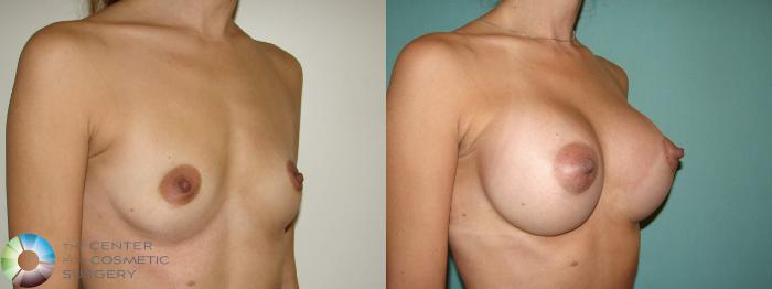 Before & After Breast Augmentation Case 10941 Right Oblique in Denver and Colorado Springs, CO