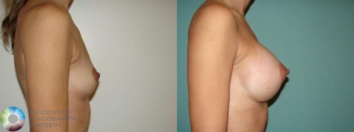 Before & After Breast Augmentation Case 10941 Right Side in Denver and Colorado Springs, CO