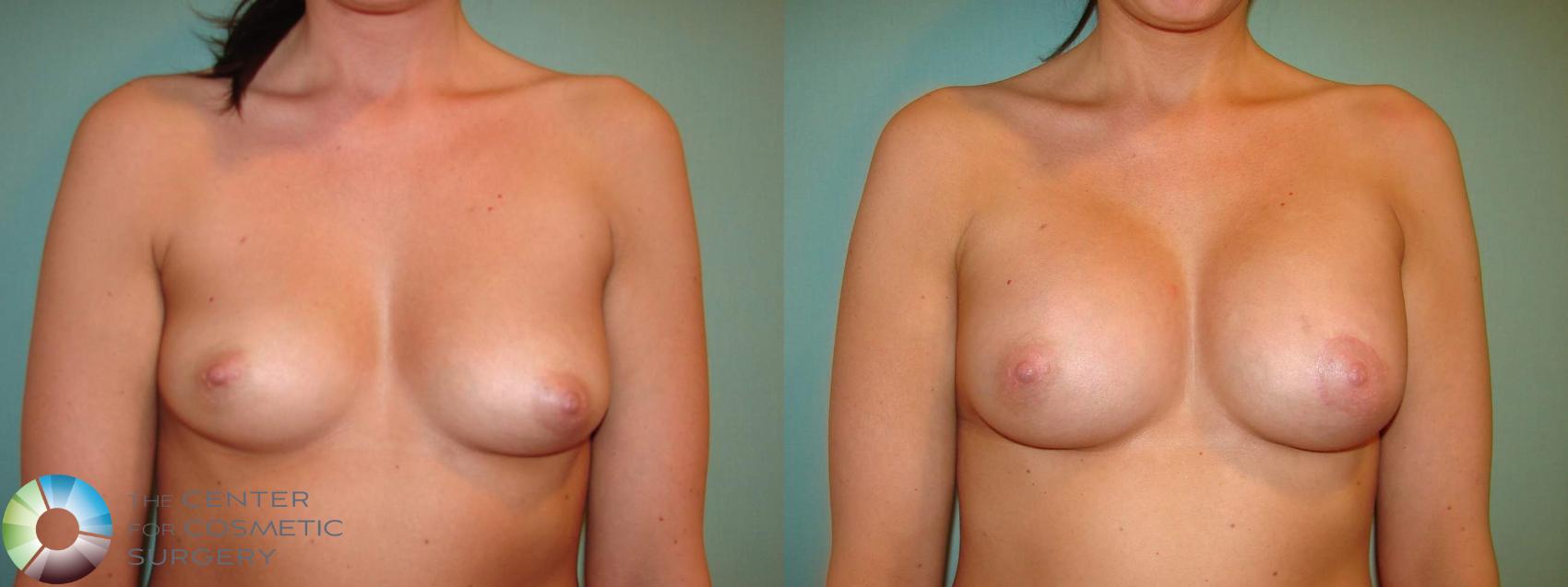 Before & After Breast Augmentation Case 10951 Anterior View in Golden, CO