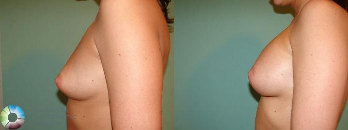 Before & After Breast Augmentation Case 10951 Left Lateral View in Golden, CO