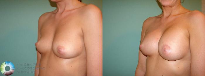 Before & After Breast Augmentation Case 10951 Left Oblique View in Golden, CO