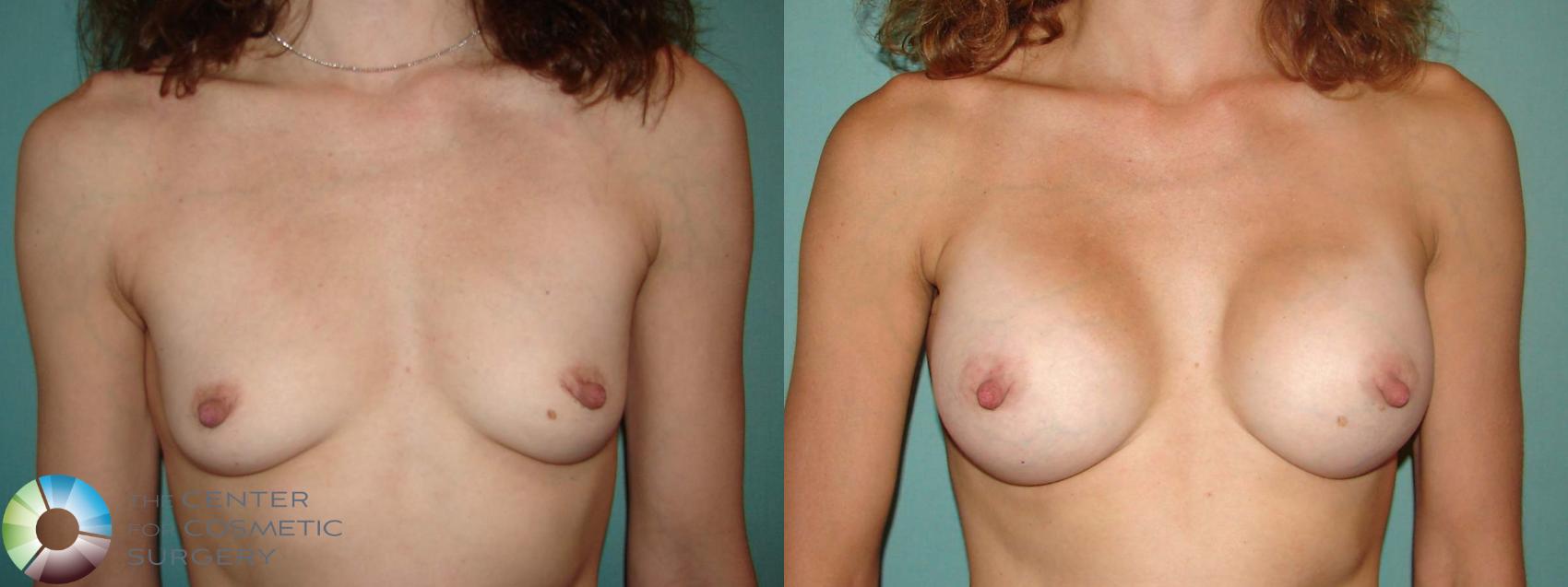 Before & After Breast Augmentation Case 10969 Anterior in Denver and Colorado Springs, CO