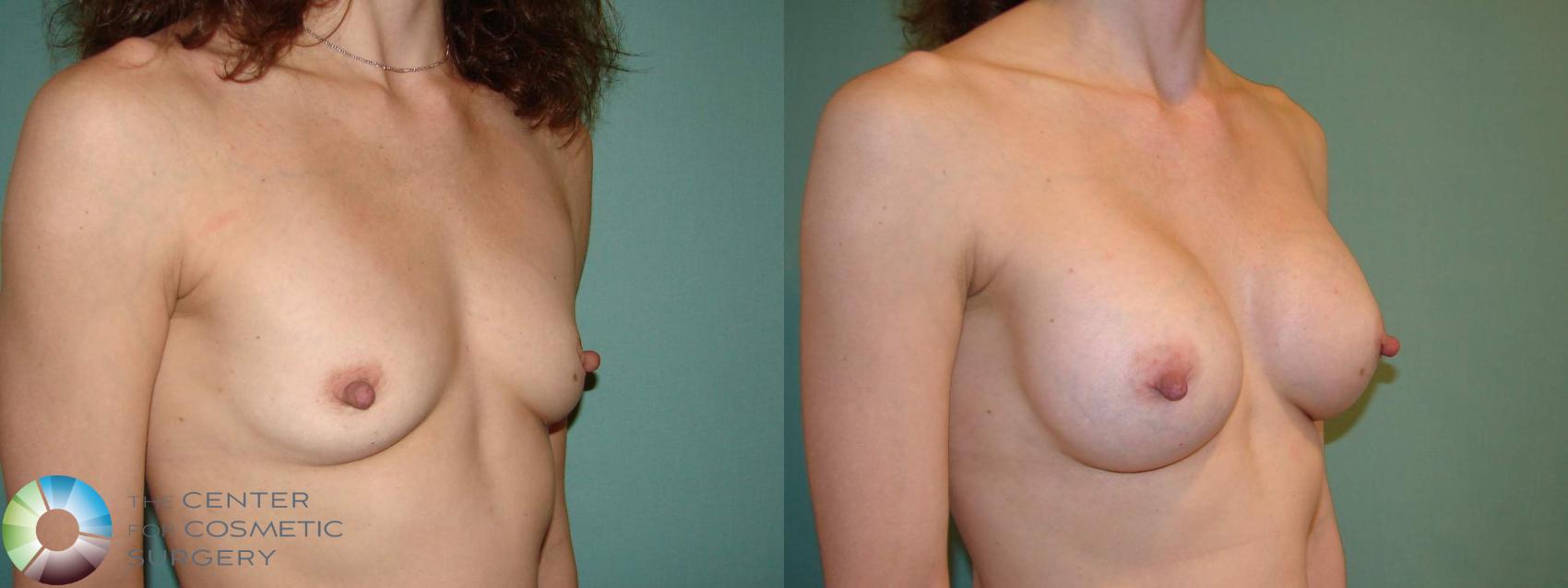 Before & After Breast Augmentation Case 10969 Right oblique in Denver and Colorado Springs, CO