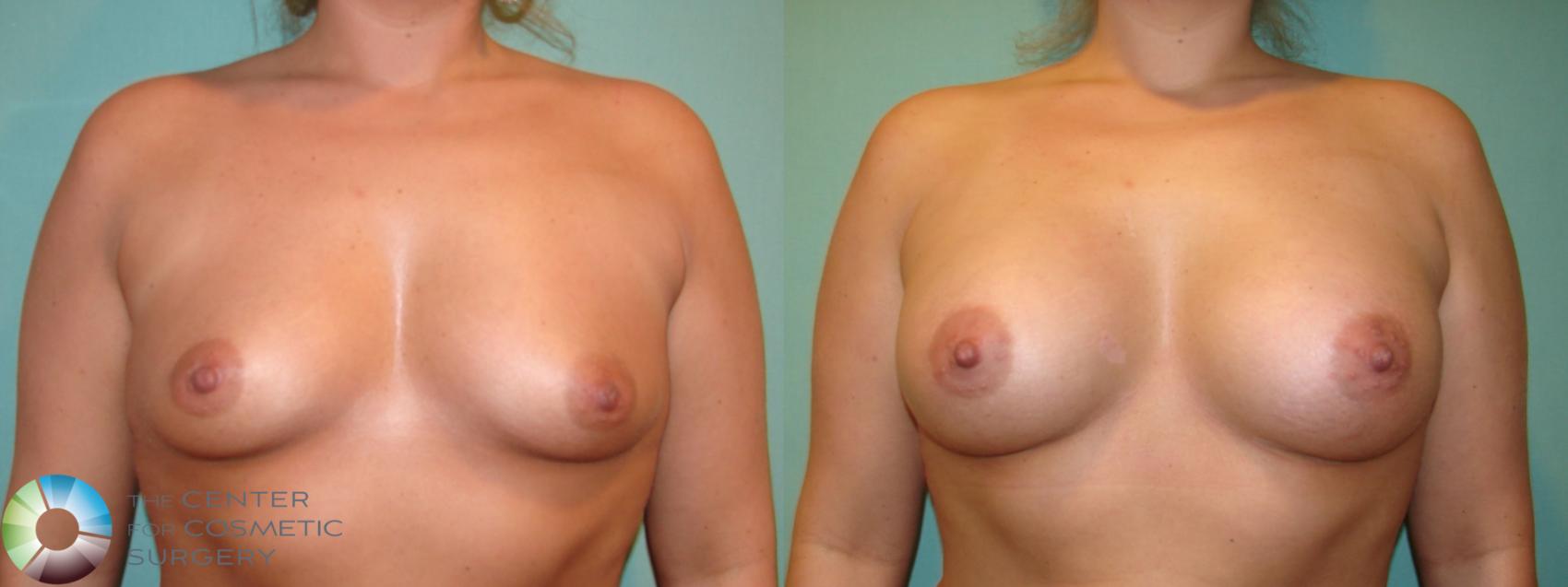 Before & After Breast Augmentation Case 10999 Anterior in Denver and Colorado Springs, CO
