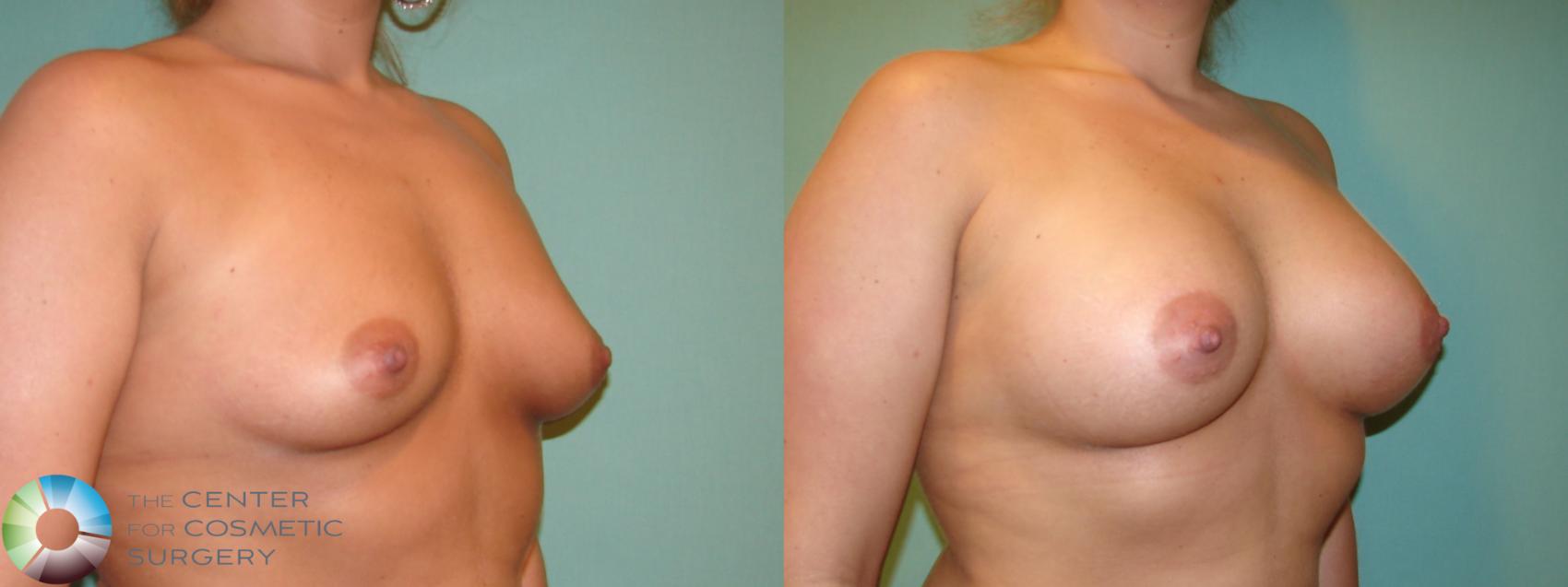 Before & After Breast Augmentation Case 10999 Right oblique in Denver and Colorado Springs, CO