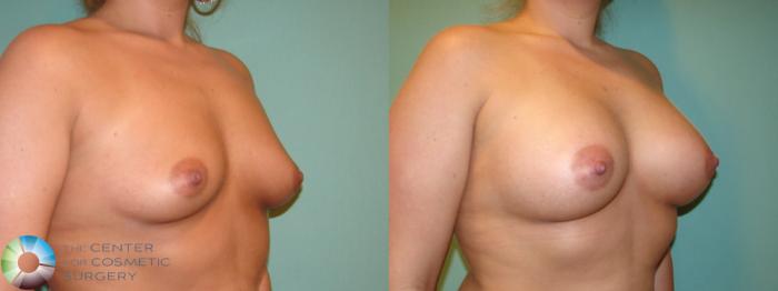 Before & After Breast Augmentation Case 10999 Right oblique in Denver and Colorado Springs, CO