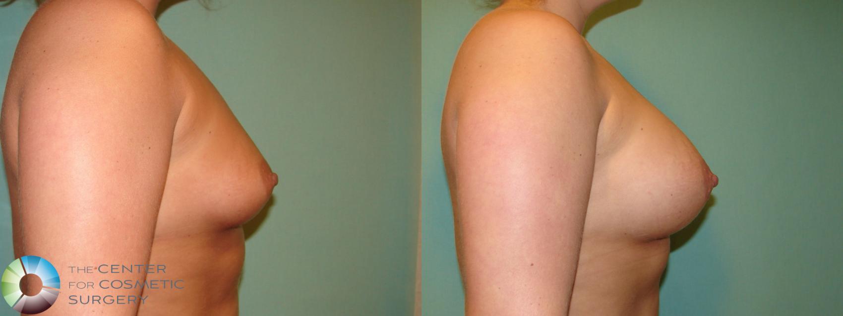 Before & After Breast Augmentation Case 10999 Right side in Denver and Colorado Springs, CO