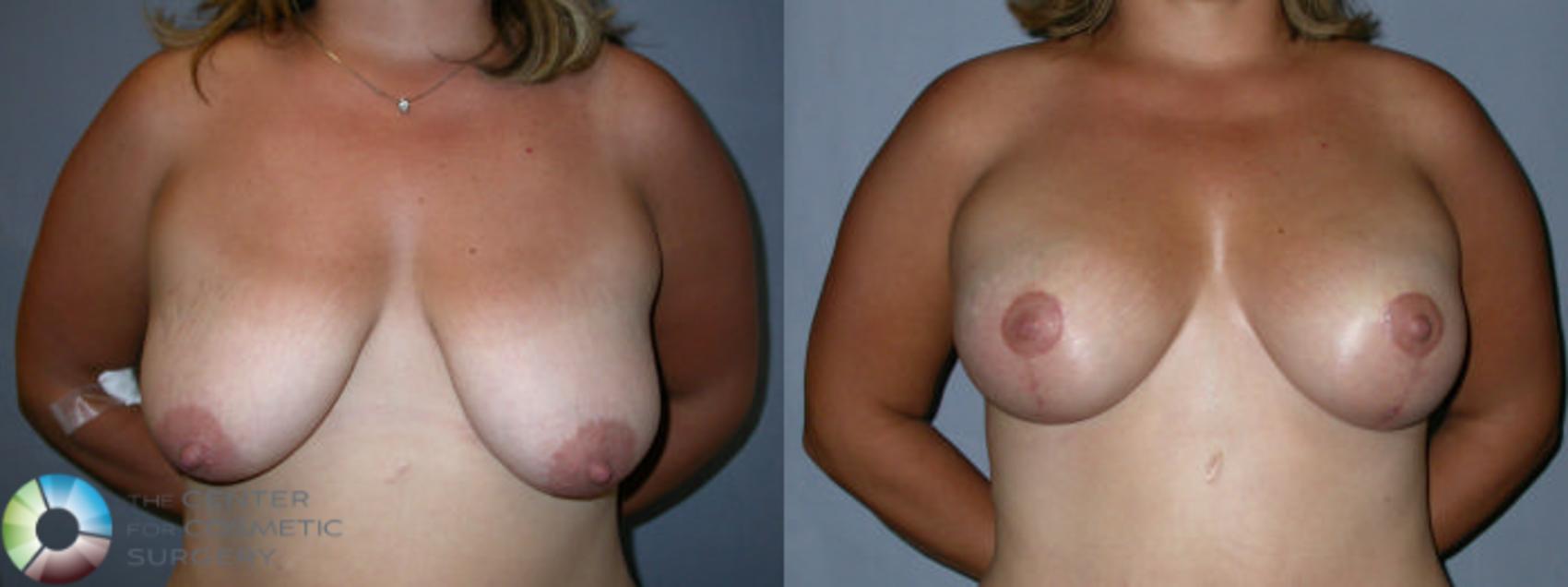 Before & After Breast Lift Case 11 View #1 in Denver and Colorado Springs, CO