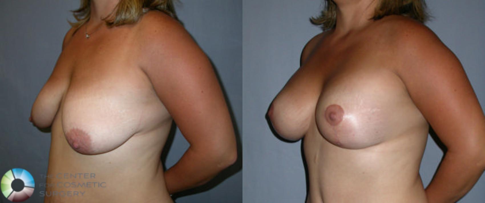 Before & After Breast Augmentation Case 11 View #2 View in Golden, CO