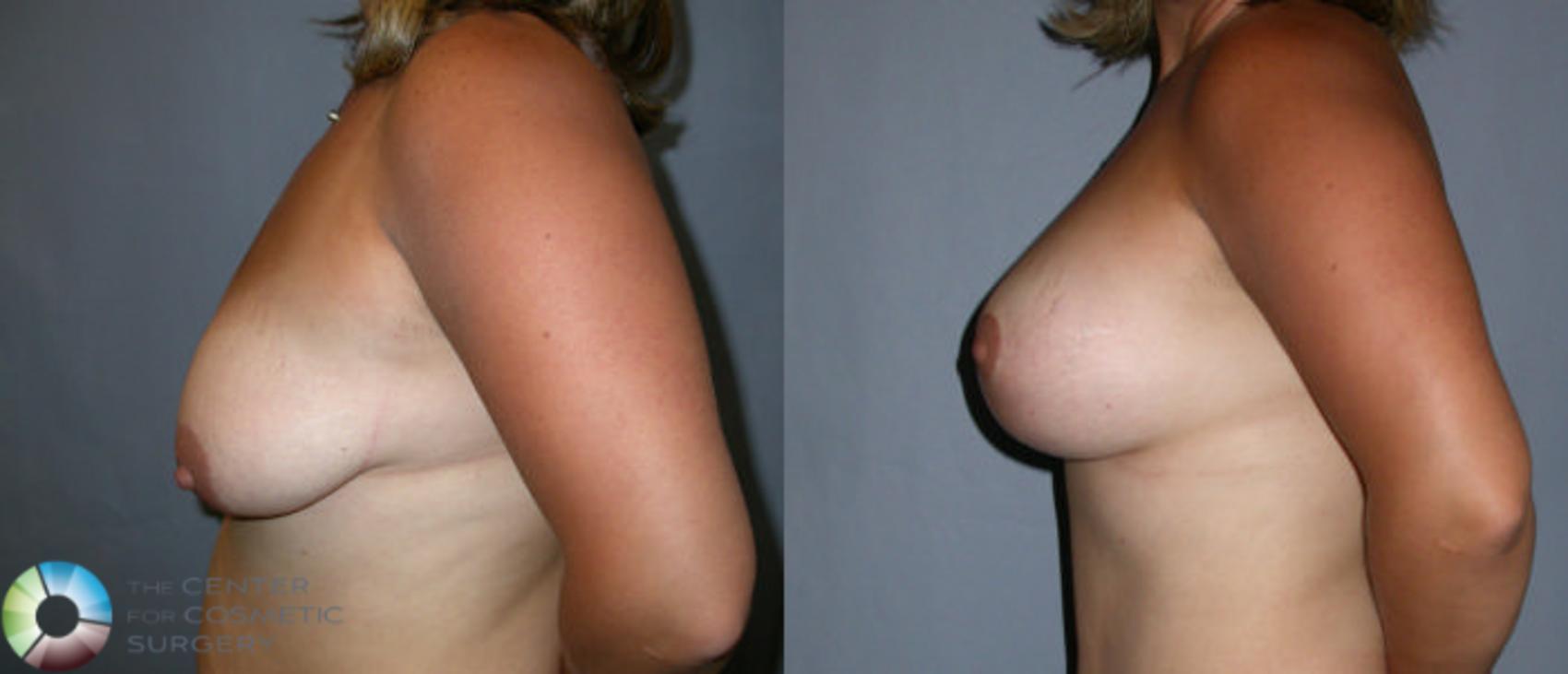 Before & After Breast Augmentation Case 11 View #3 View in Golden, CO