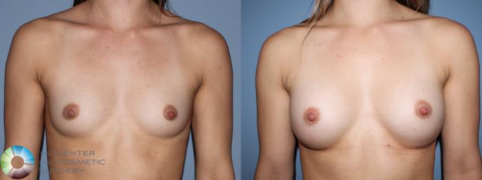 Before & After Breast Augmentation Case 11107 Anterior View in Golden, CO