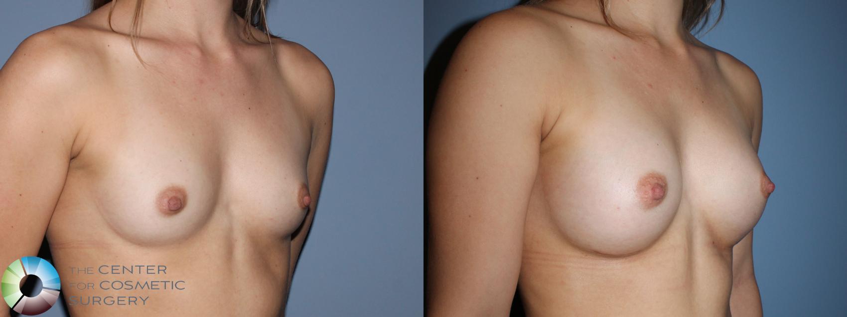 Before & After Breast Augmentation Case 11107 Right oblique View in Golden, CO