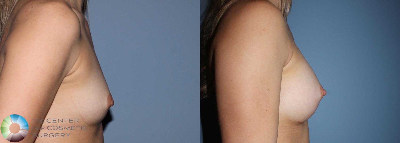 Before & After Breast Augmentation Case 11107 Right side in Denver and Colorado Springs, CO