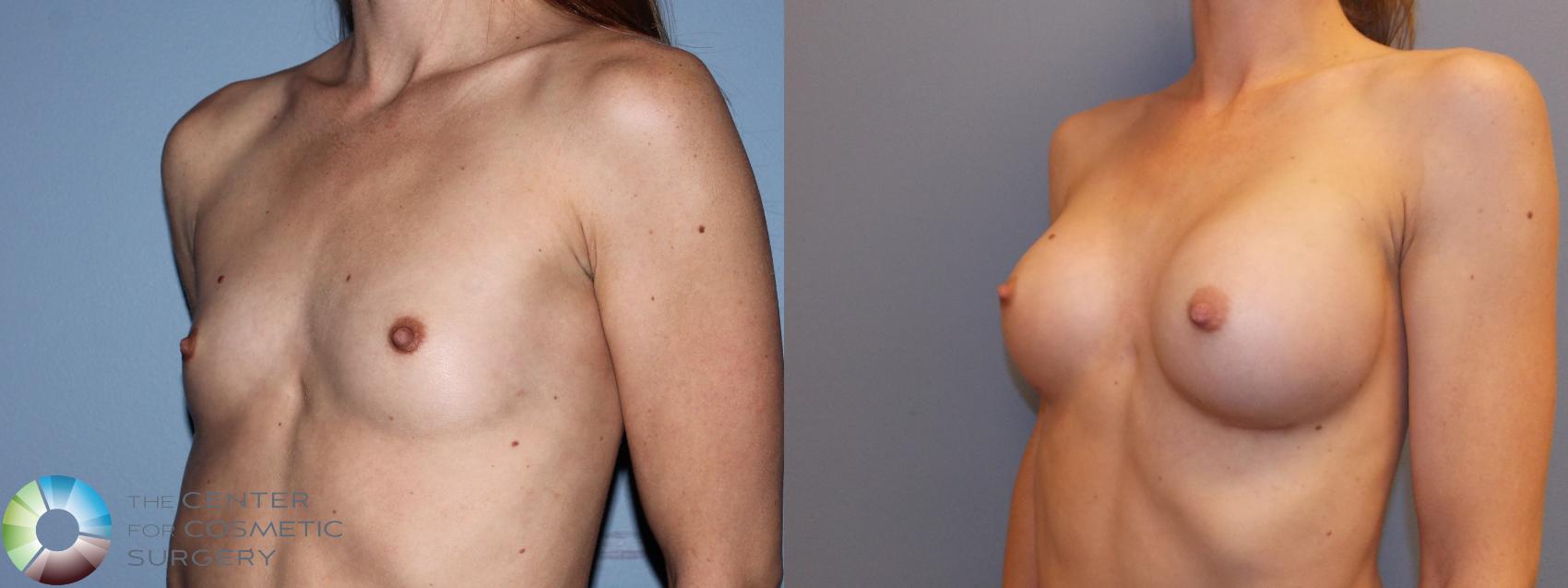 Before & After Breast Augmentation Case 11108 Left Oblique in Denver and Colorado Springs, CO