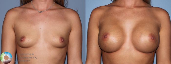 Before & After Breast Augmentation Case 11109 Anterior View in Golden, CO