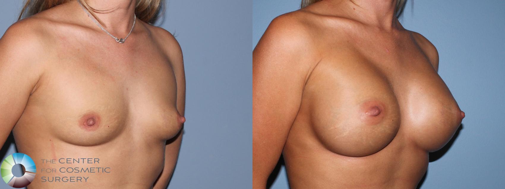 Before & After Breast Augmentation Case 11109 Right oblique in Denver and Colorado Springs, CO