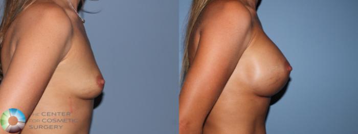Before & After Breast Augmentation Case 11109 Right Side View in Golden, CO