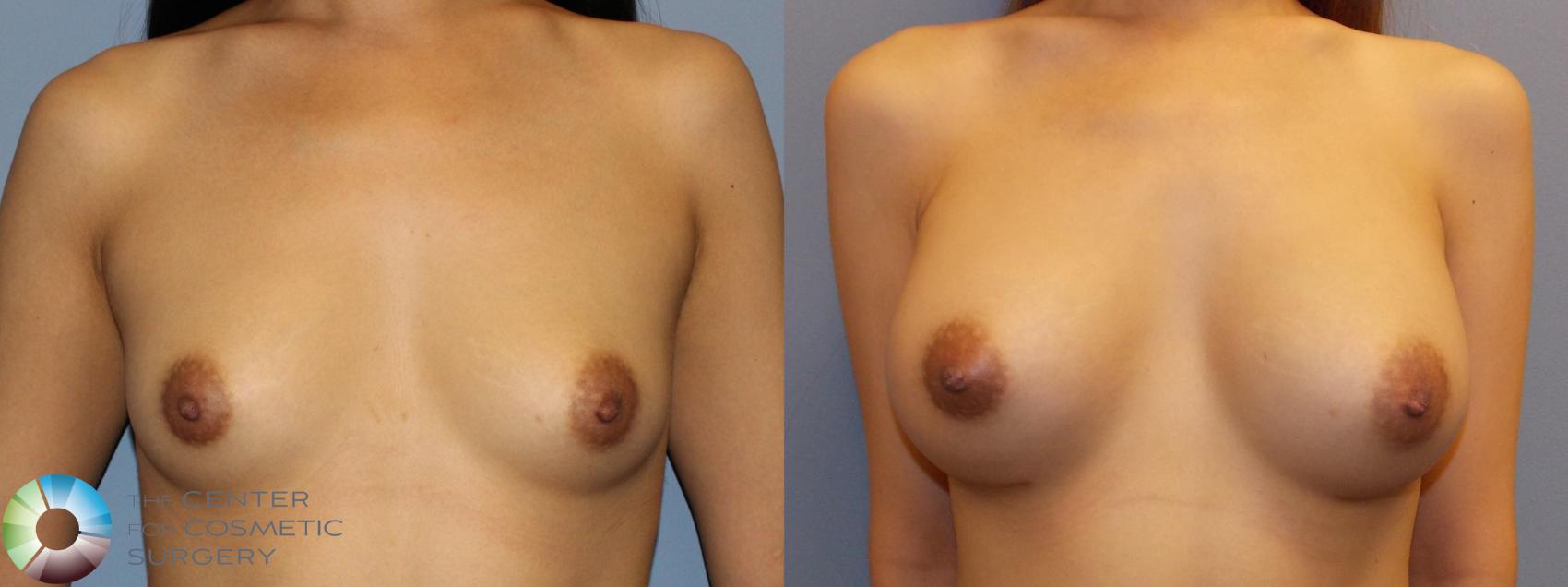 Before & After Breast Augmentation Case 11112 Anterior in Denver and Colorado Springs, CO