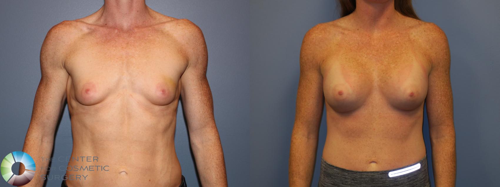 Before & After Breast Augmentation Case 11197 Front View in Denver & Golden, CO