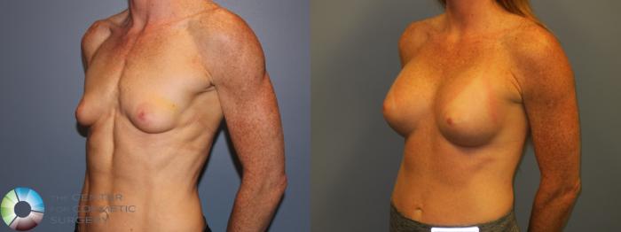 Before & After Breast Augmentation Case 11197 Right Oblique in Denver and Colorado Springs, CO