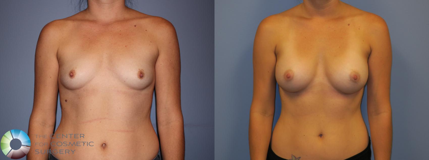 Before & After Breast Augmentation Case 11198 Front View in Denver & Golden, CO
