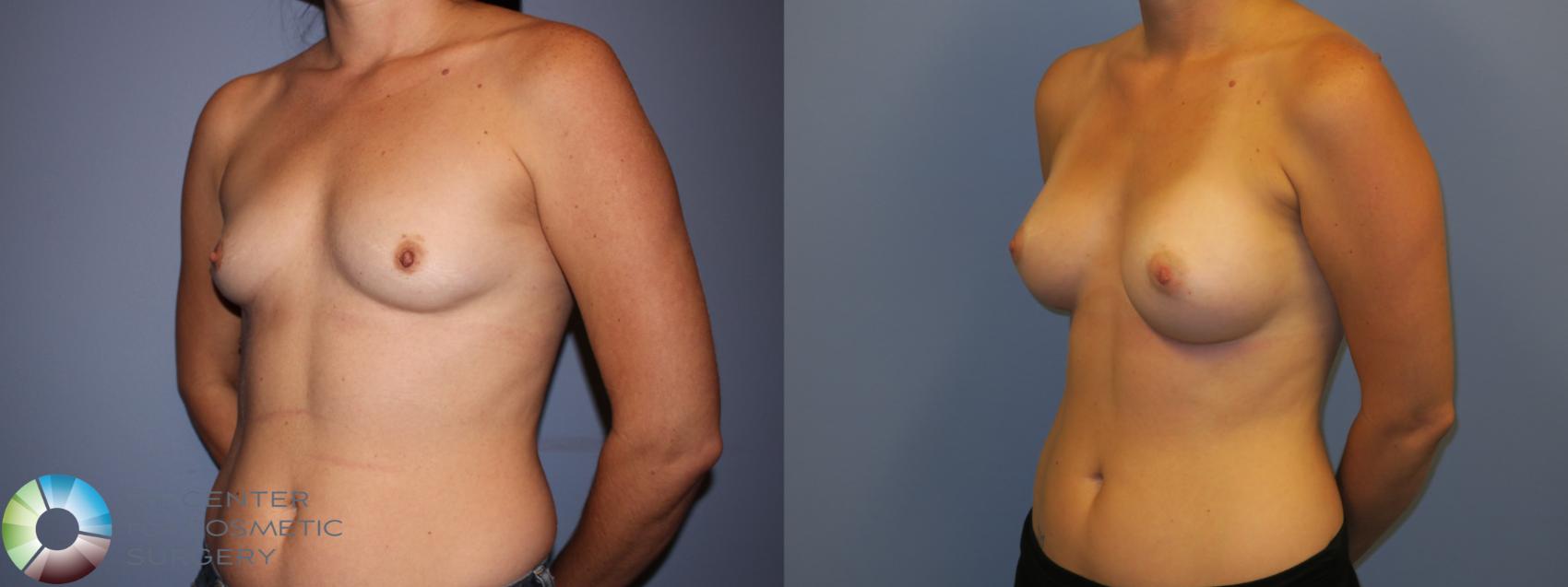 Before & After Breast Augmentation Case 11198 Left Oblique View in Denver & Golden, CO