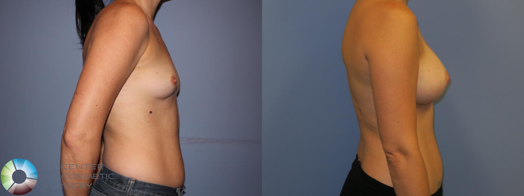 Before & After Breast Augmentation Case 11198 Right Side View in Denver & Golden, CO