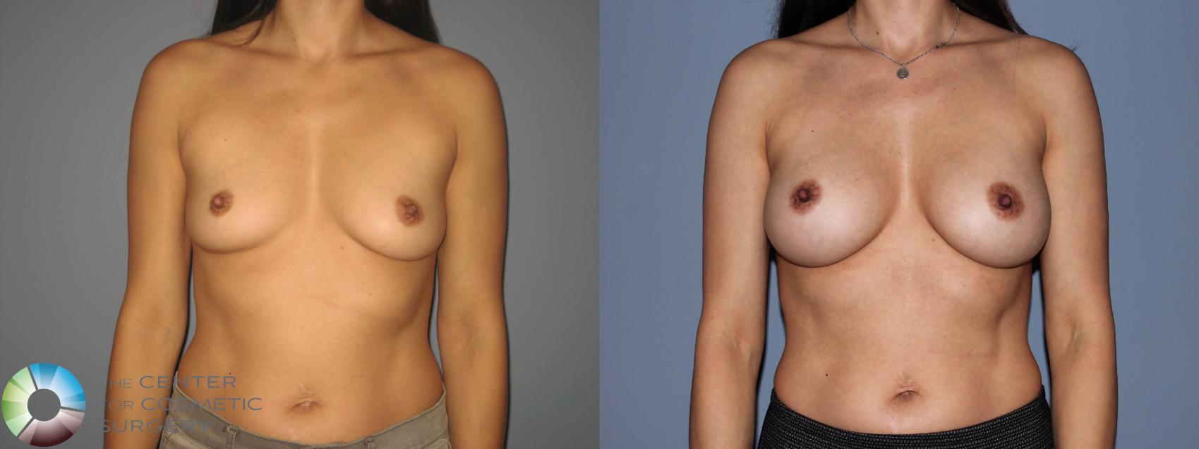 Before & After Breast Augmentation Case 11206 Front in Denver and Colorado Springs, CO