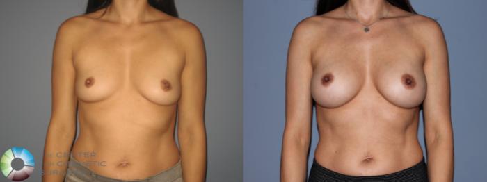 Before & After Breast Augmentation Case 11206 Front View in Golden, CO
