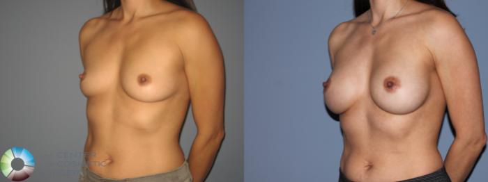 Before & After Breast Augmentation Case 11206 Left Oblique View in Golden, CO