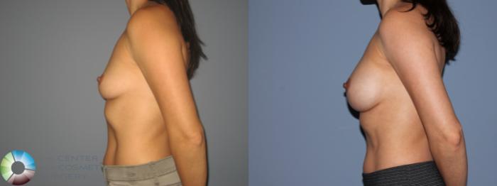Before & After Breast Augmentation Case 11206 Left Side View in Golden, CO