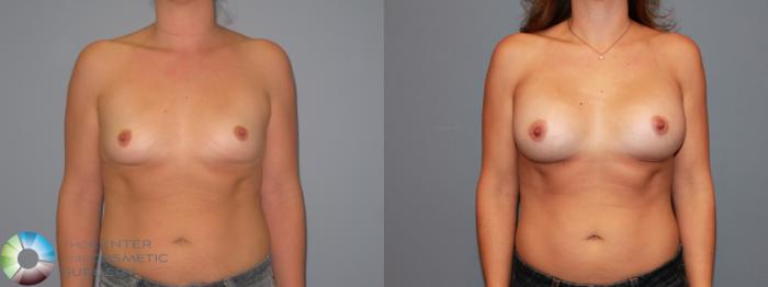 Before & After Breast Augmentation Case 11207 Front View in Golden, CO