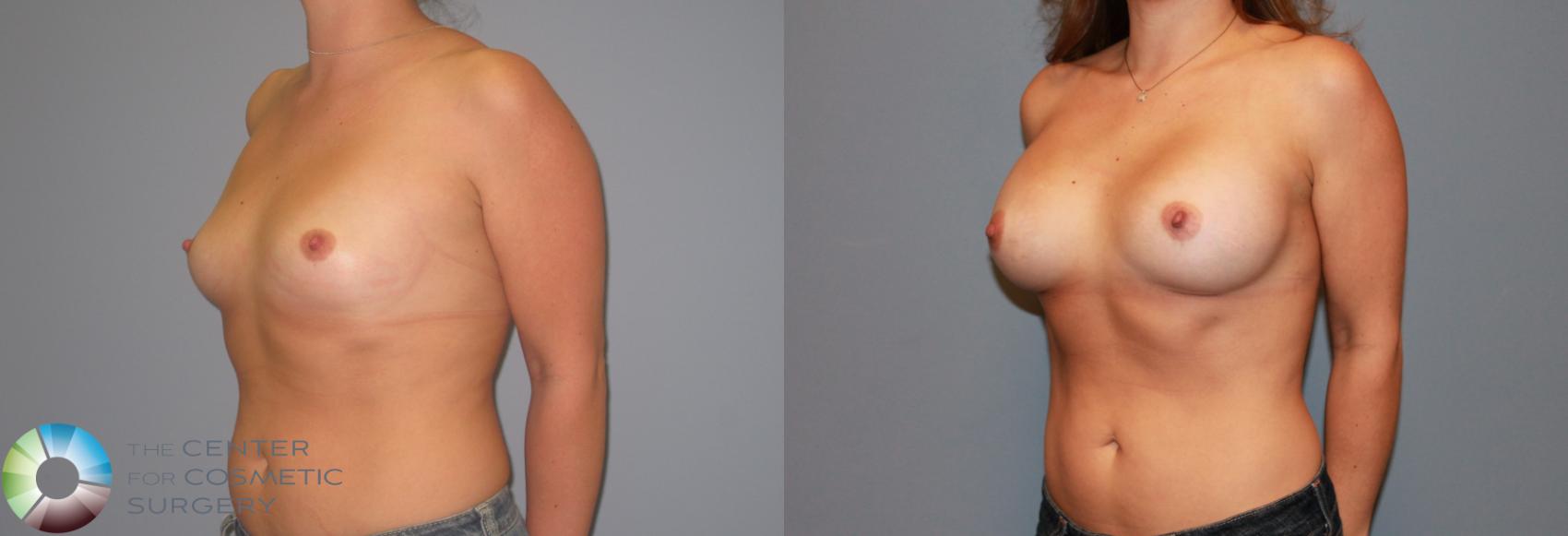 Before & After Breast Augmentation Case 11207 Left Oblique View in Golden, CO