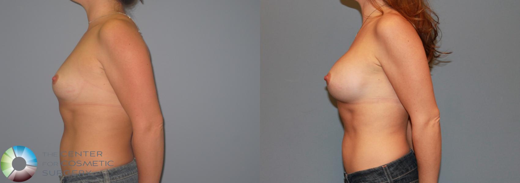 Before & After Breast Augmentation Case 11207 Left Side View in Golden, CO